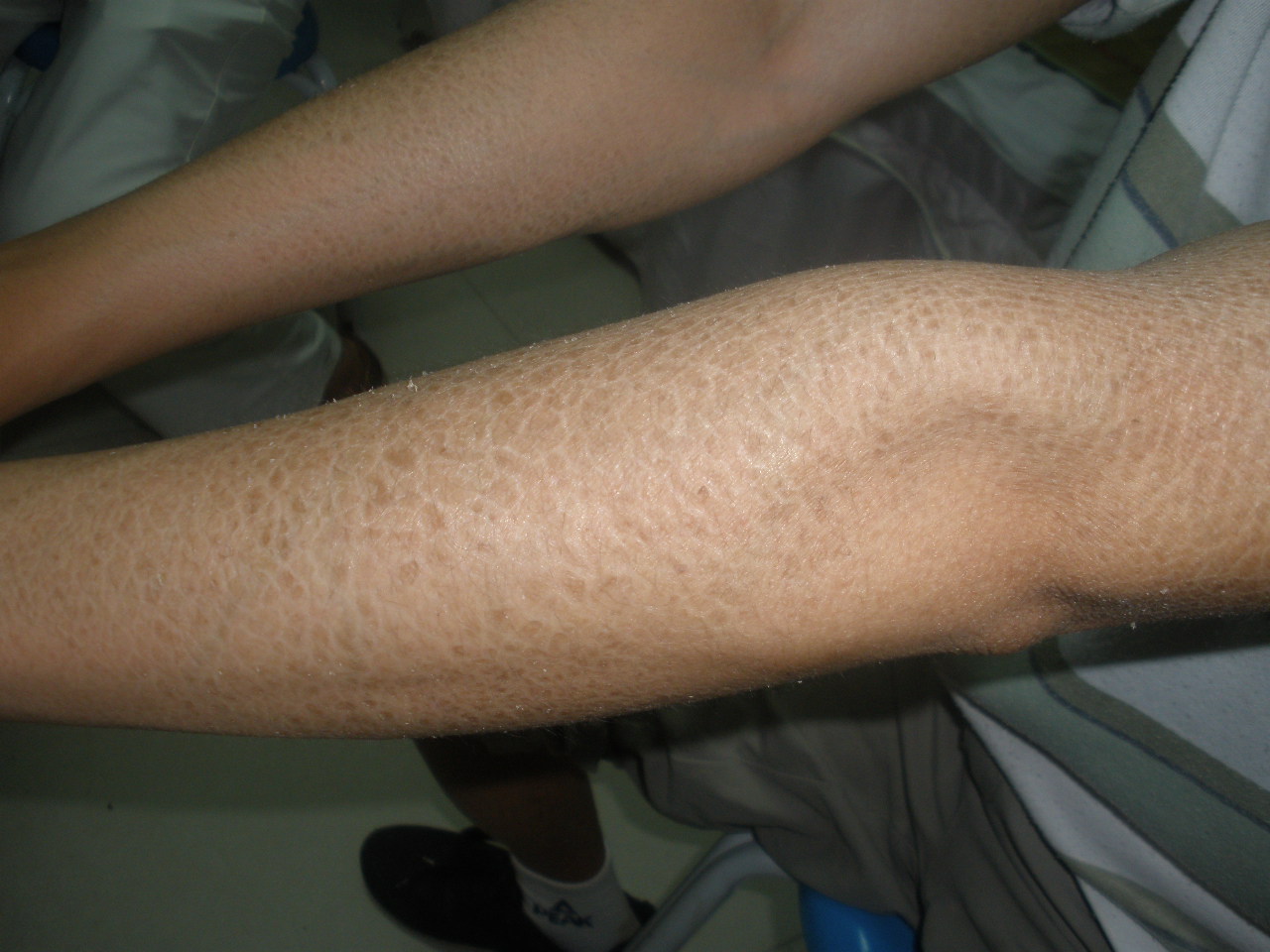 郑州鱼鳞病是什么原因引起蛇皮癣即鱼鳞病,是一种常见的遗传性皮肤